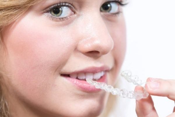 Ortodonzia Invisibile Bambini: Quando Iniziare e Quali Sono le Alternative al Tradizionale