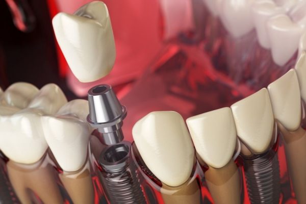 Implantologia computer guidata Roma: vantaggi, cliniche e tempi