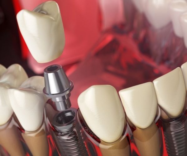 Implantologia computer guidata Roma: vantaggi, cliniche e tempi