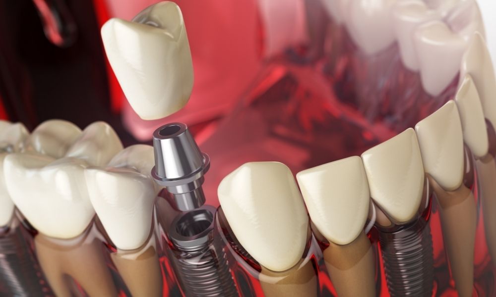 Implantologia computer guidata Roma: vantaggi, cliniche e tempi