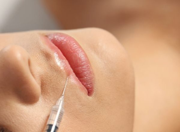 Lifting Labbra Roma: Tecniche, Risultati e Tempi di Recupero